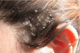 Seborrheic Dermatitis & Dry Scalp Eczema